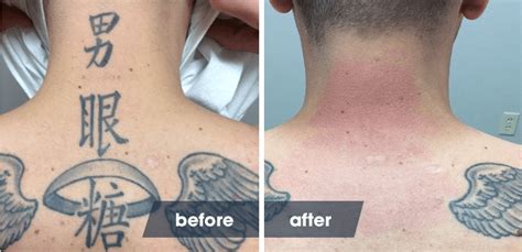 laser tattoo removal timeline